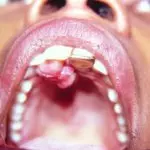 Ботриомикома во рту